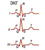 Электрокардиография (классические биполярные отведения) (2)