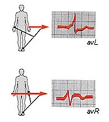 Электрокардиография (униполярные отведения) (1)