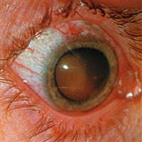 Эндофтальмит