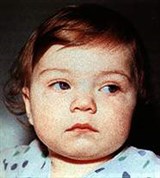 Эпидемический паротит