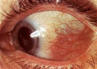 Эписклерит