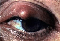 Ячмень верхнего века