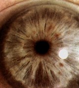 Глаукома. атрофия радужной оболочки