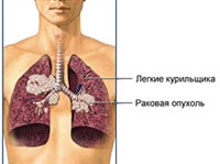 Курение и органы дыхания (легкие курильщика)