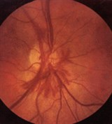 Начальная диабетическая ретинопатия