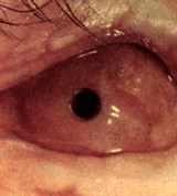 Ожог глаза