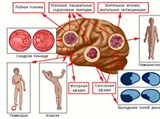 Опухоли лобной, височной и затылочной областей головного мозга