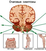 Опухоли мозжечка и ствола головного мозга (клинические симптомы)