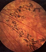Пигментная дистрофия сетчатки (периферия глазного дна)