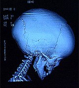 Томографический скан черепа